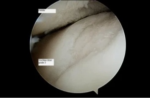 Look Astro scope on the knee joint with osteoarthritis 3. Degree