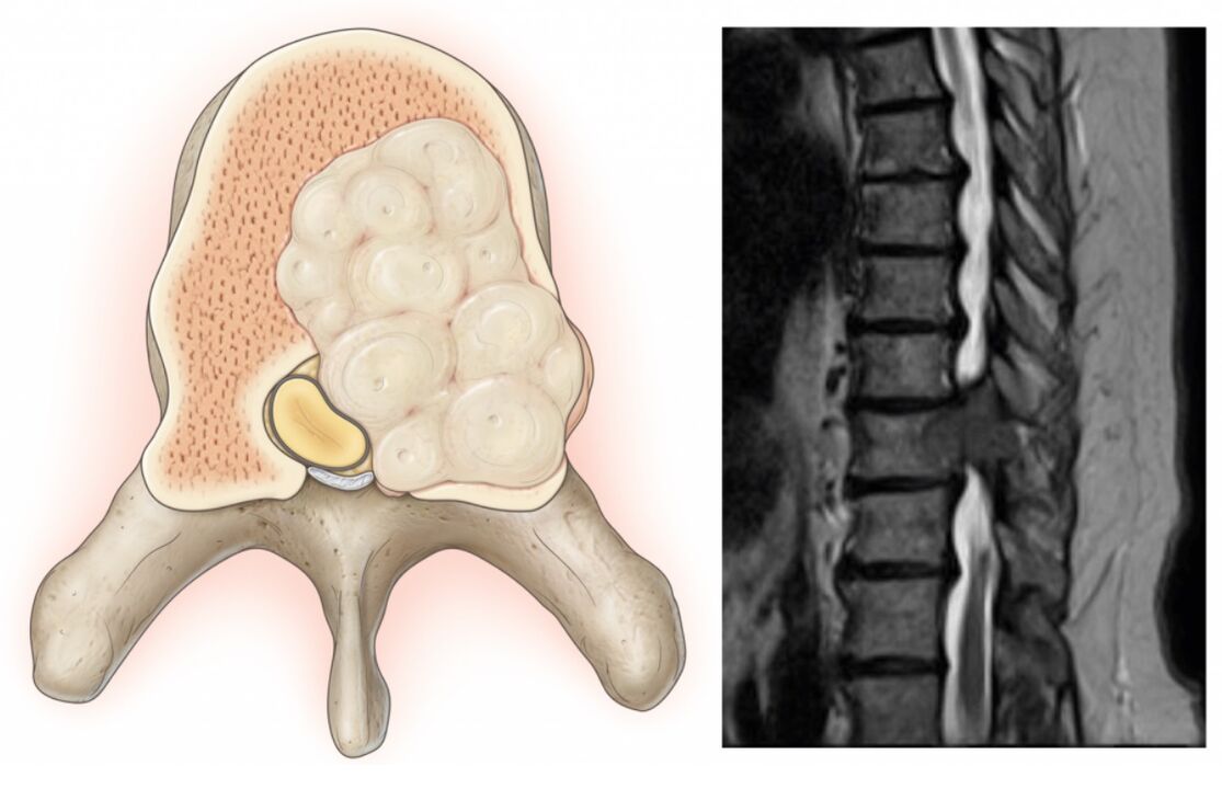 Swelling in the spine leads to back pain