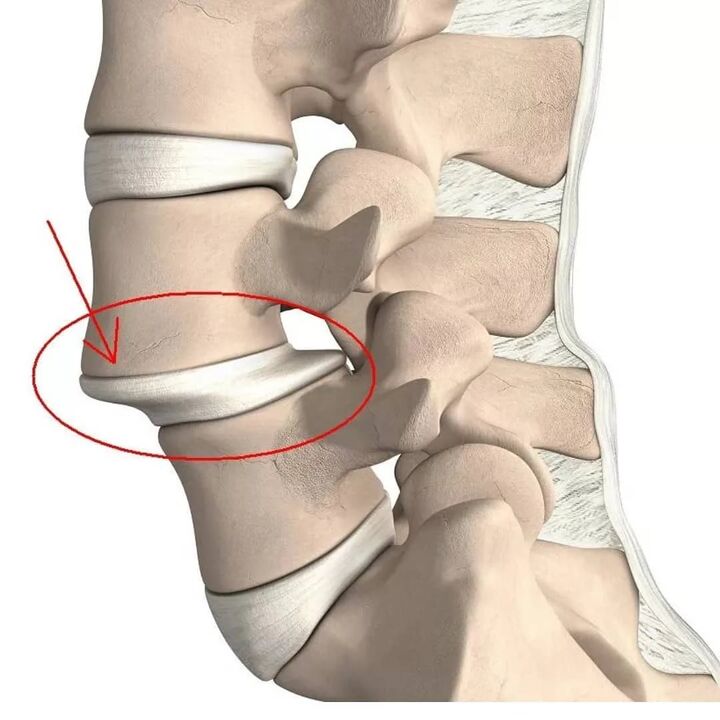 Vertebral injuries