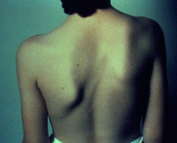 Sprengel's disease as the cause of pain under the left shoulder blade