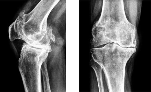 X-ray of gonarthrosis of the knee