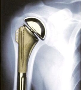 Shoulder prosthesis in osteoarthritis