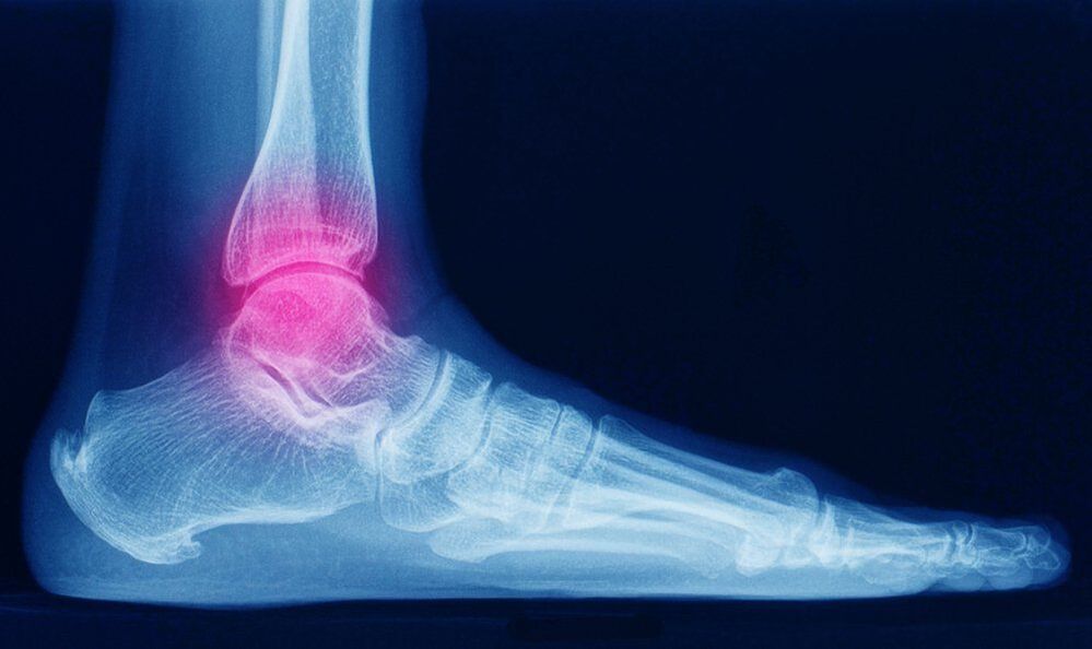 Symptoms of ankle osteoarthritis