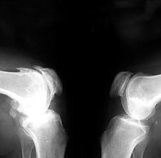 Osteoarthritis on the x-ray image