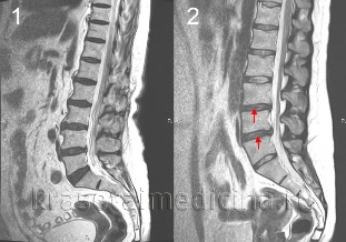 Osteochondrosis of the spine