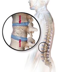 Osteoporosis causes back pain in the lumbar area