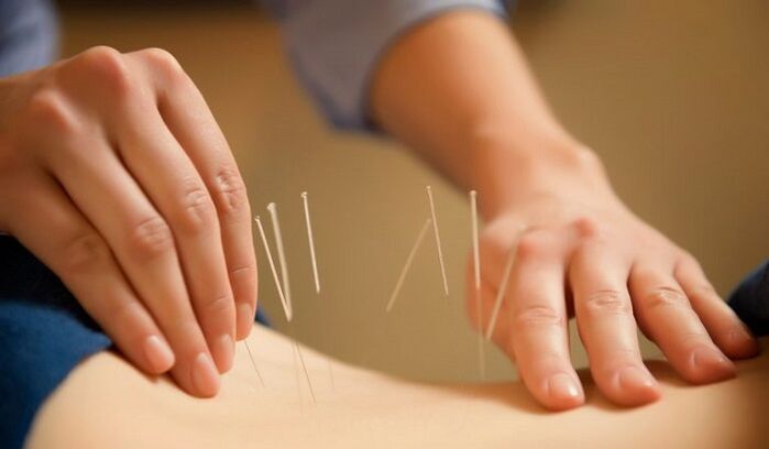 Acupuncture used to treat back pain