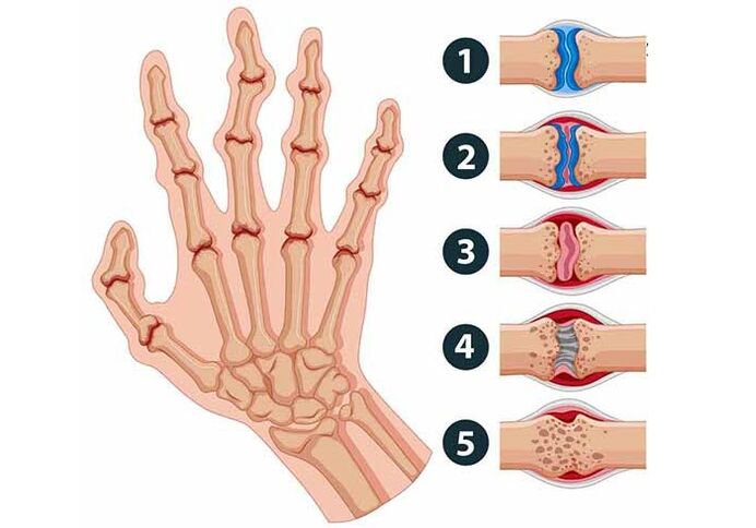 Stages of development of arthritis of the finger joints