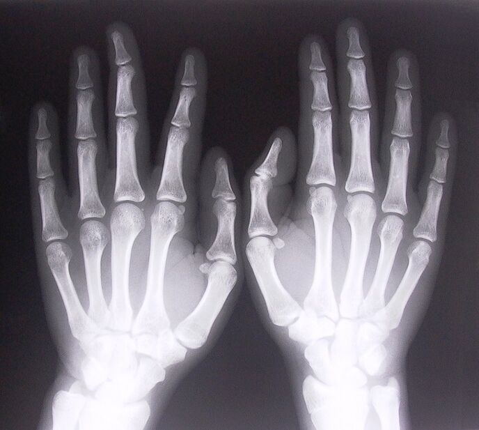 X-ray used to diagnose pain in the finger joints